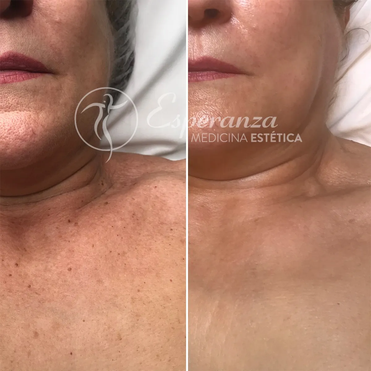 fotorrejuvenencimiento-plasencia-centro-estetica-esperanza-1