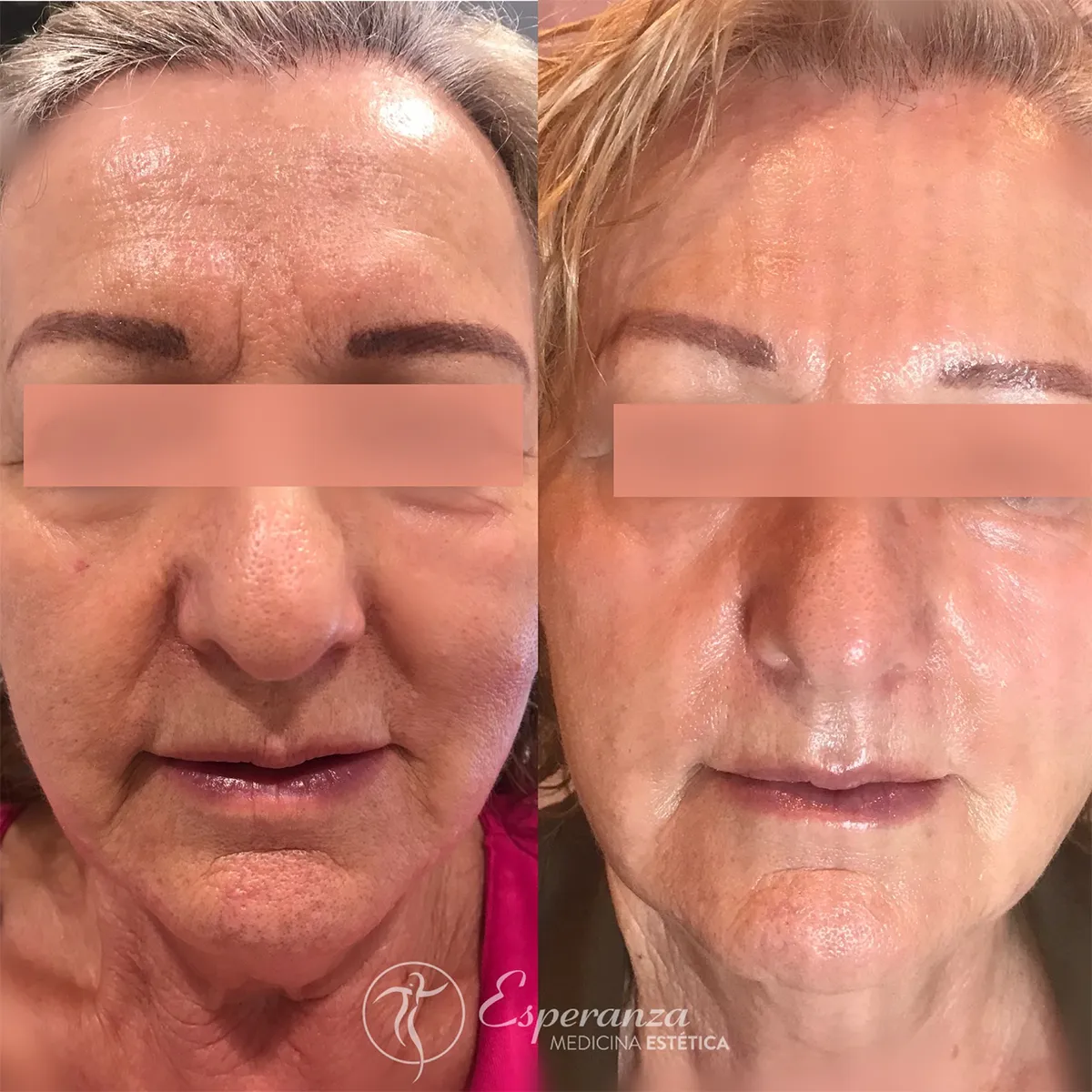 fotorrejuvenencimiento-plasencia-centro-estetica-esperanza-2