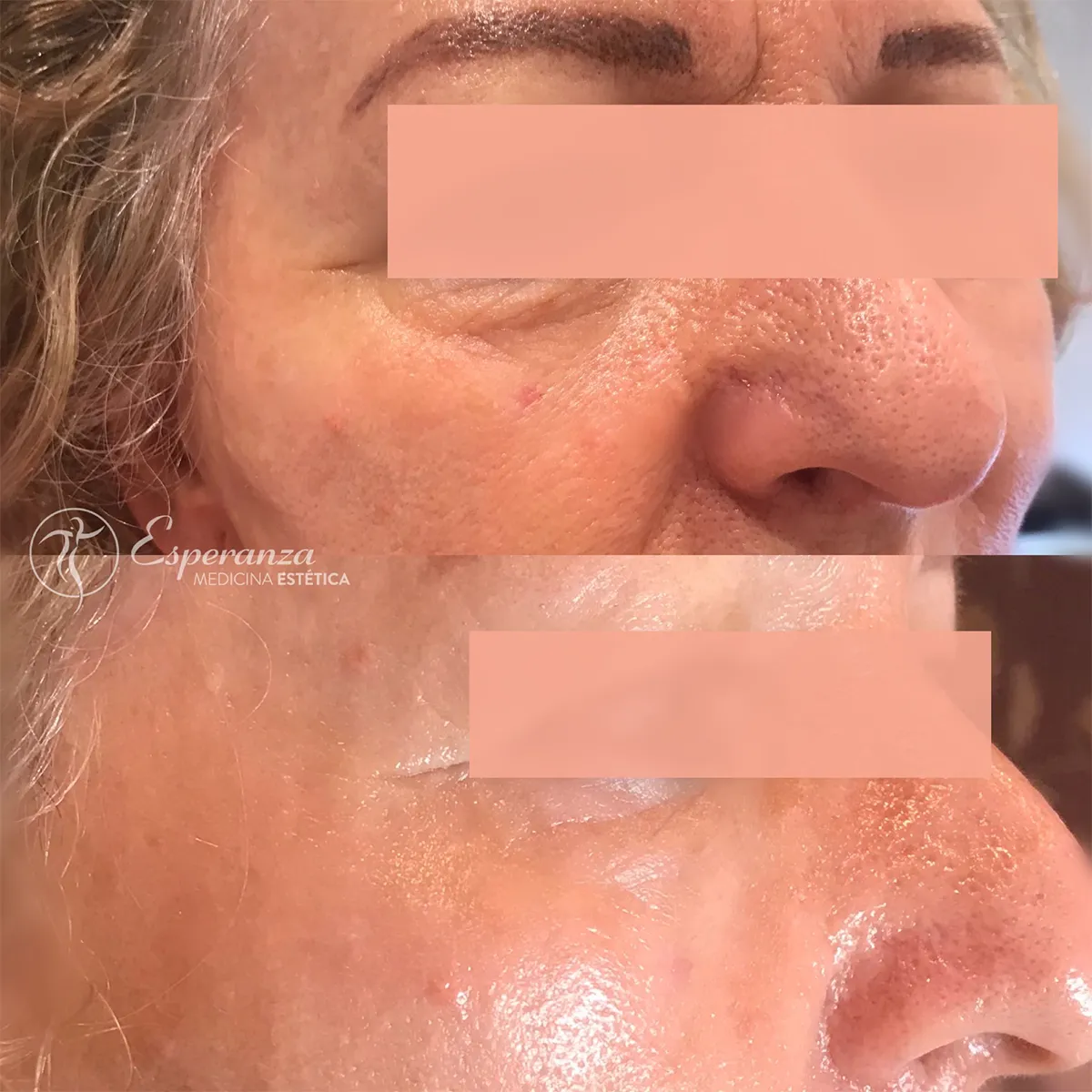 fotorrejuvenencimiento-plasencia-centro-estetica-esperanza-3