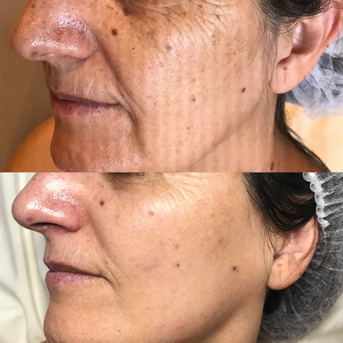 fotorrejuvenencimiento-plasencia-centro-estetica-esperanza