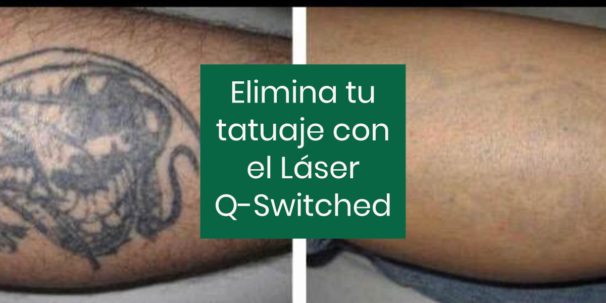 Estás cansado de tu tatuaje? Eliminarlos por fin es posible