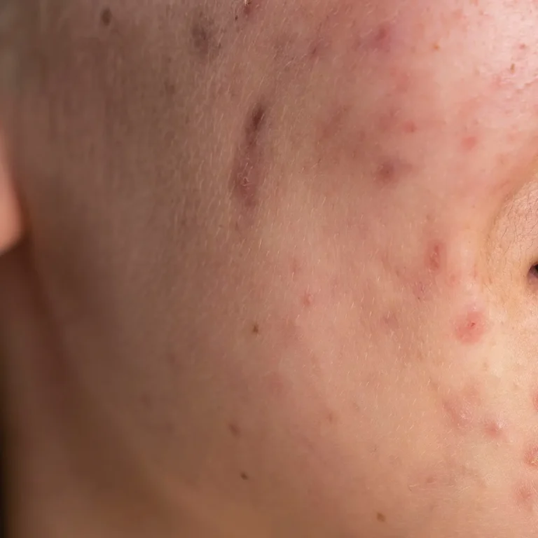 acne