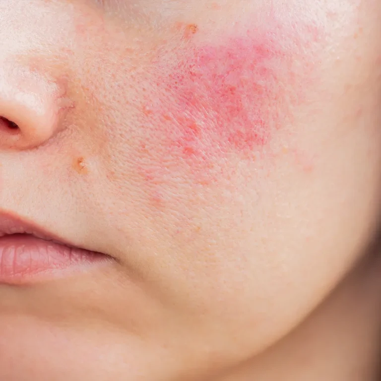 rosacea